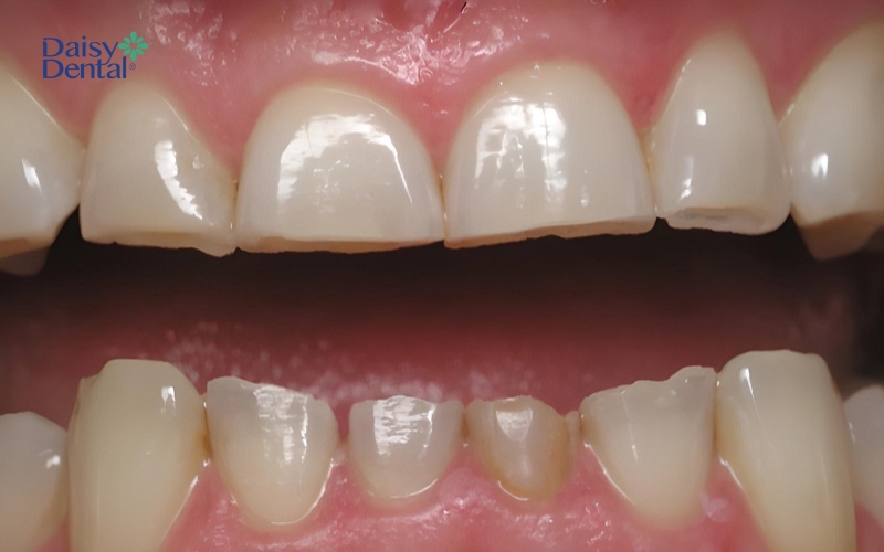 Khớp cắn đối đỉnh nếu không điều trị có thể làm mòn răng