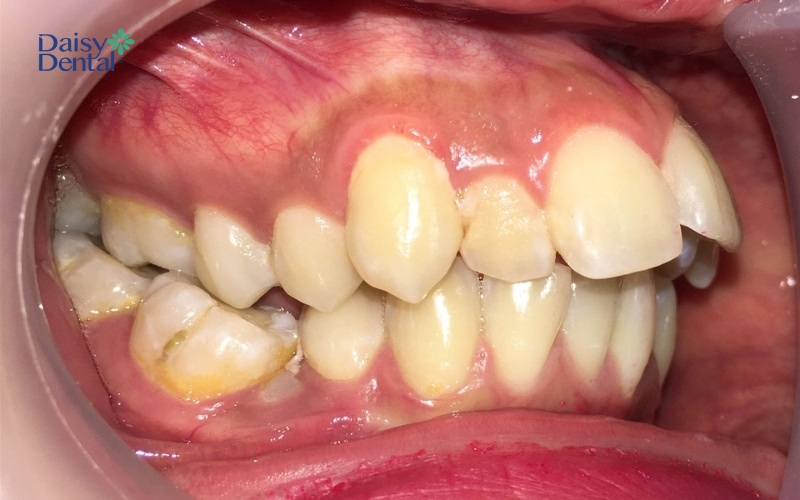 Mất cân đối giữa hai cung hàm là nguyên nhân dẫn đến tình trạng răng mọc ngược