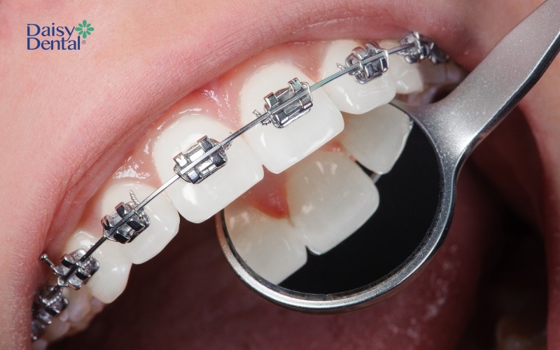Niềng răng là phương pháp giúp khắc phục tình trạng răng thừa mọc giữa 2 răng hiệu quả