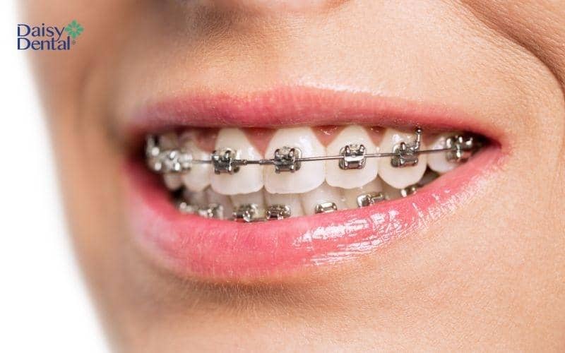 Niềng răng khắc phục môi bị lệch khi cười