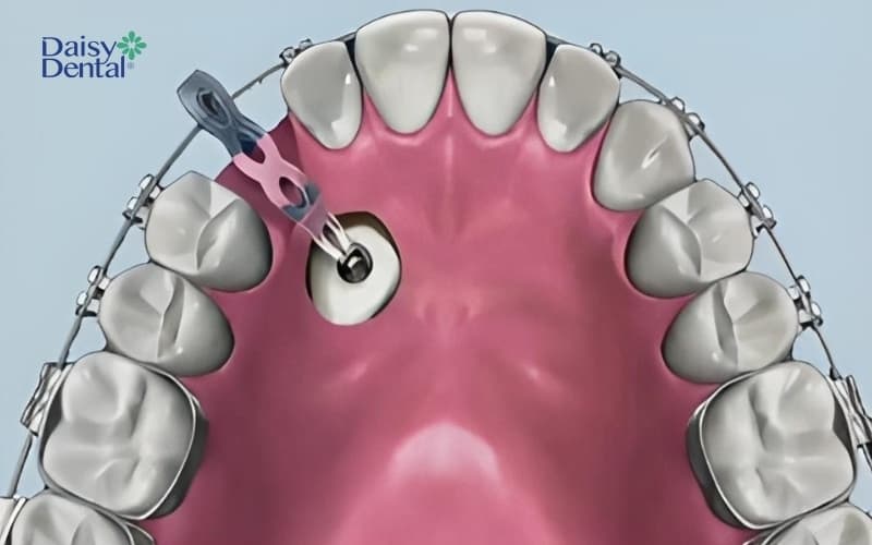 Phẫu thuật lộ răng và chỉnh nha