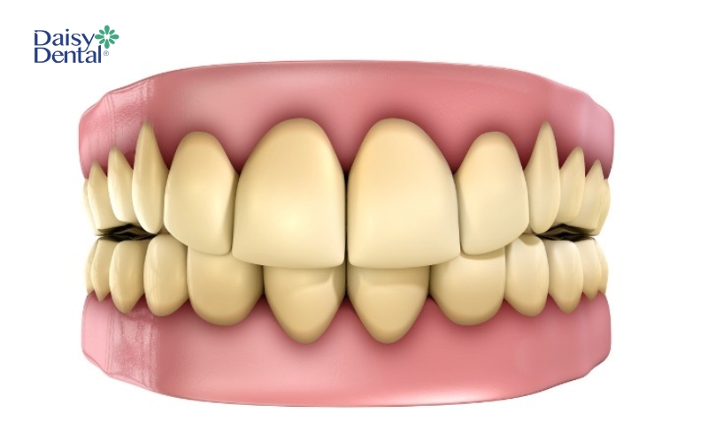 Răng bị ố vàng, nhiễm màu nặng
