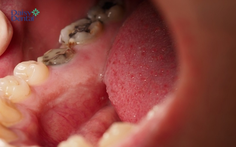 Răng bị sâu nặng, thân răng không còn nguyên vẹn thường được nha sĩ chỉ định nhổ bỏ