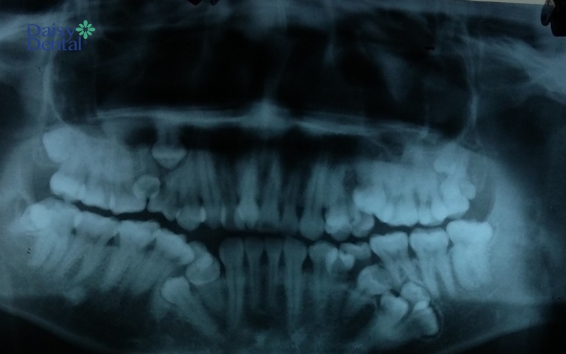 Răng dư mọc ngầm chỉ có thể nhận biết khi chụp X-quang