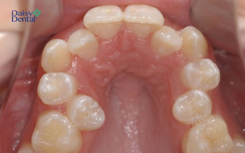 Răng mọc thừa do mầm răng phân đôi