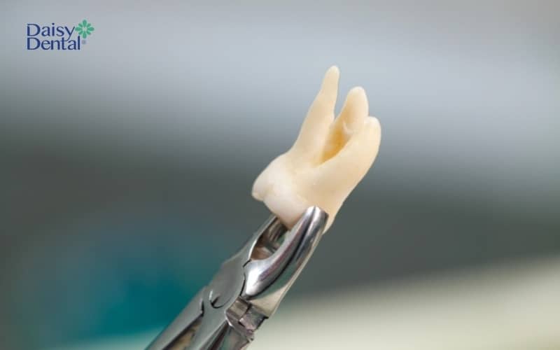 Răng nanh mọc lệch trong xương hàm được nhổ bỏ khi làm ảnh hưởng đến những chiếc răng khác