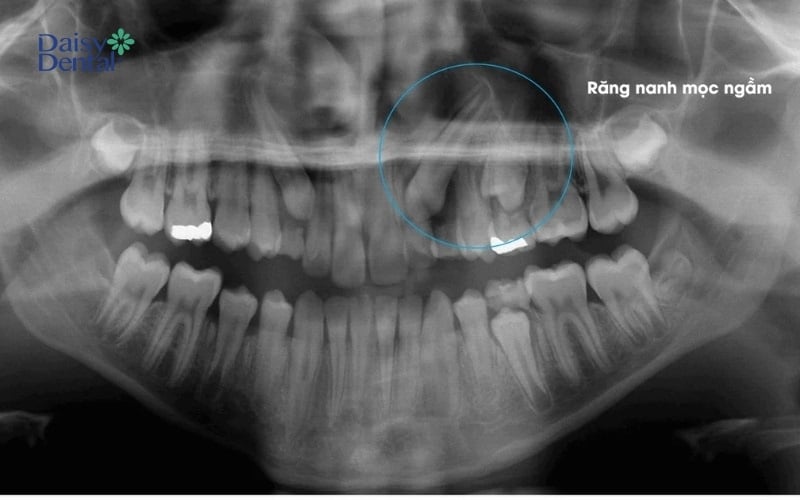Răng nanh mọc ngầm trong xương hàm, không xuất hiện như bình thường