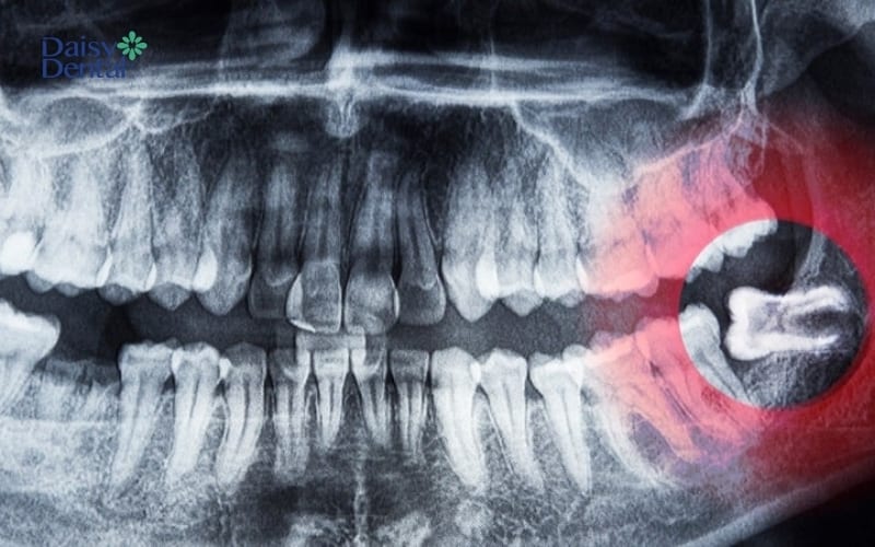 Răng số 8 mọc ngầm thường được nhổ bỏ