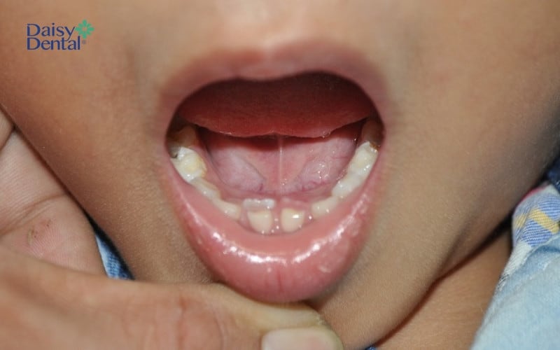 Răng sữa còn ở trên cung hàm khiến răng vĩnh biễn mọc lệch