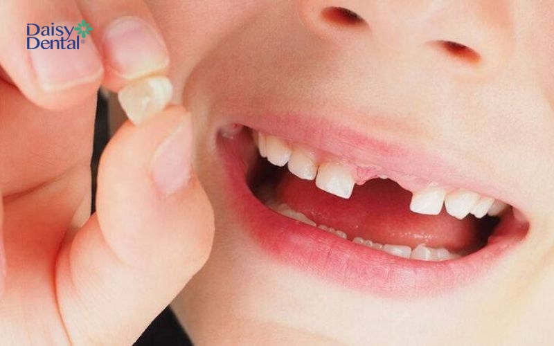 Răng sữa sẽ tự rụng đi nếu trẻ đang trong quá trình thay răng