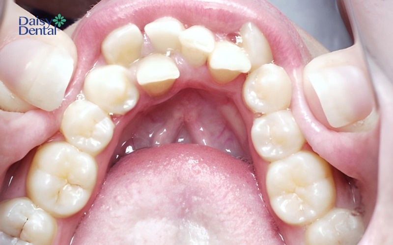 Răng thừa có thể xuất hiện do mầm răng phân đôi