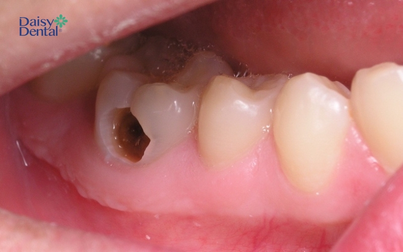 Răng trẻ bị sâu nặng cần phải nhổ bỏ