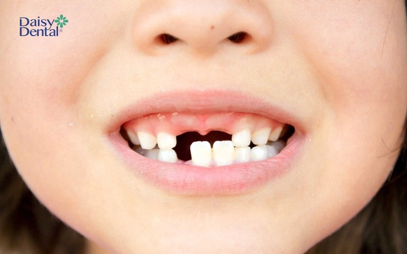 Trẻ bắt đầu thay răng cửa giữa khi được 5 - 7 tuổi