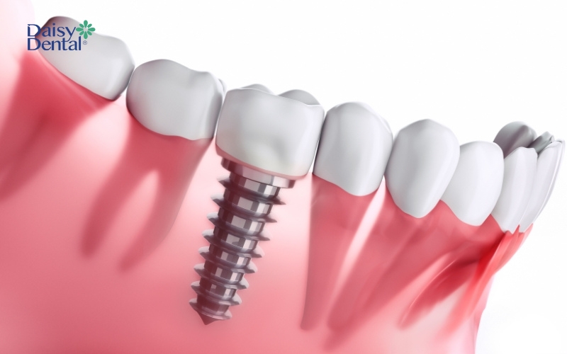 Trồng răng Implant không thể thực hiện khi trẻ dưới 18 tuổi