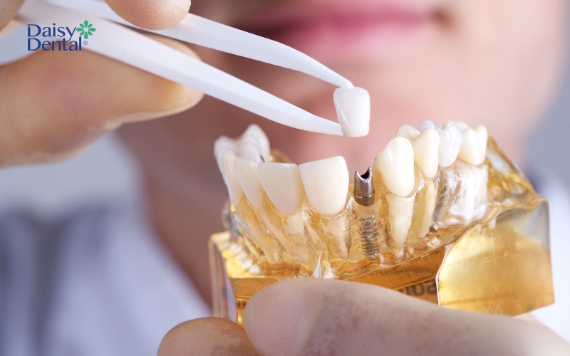 Trồng răng Implant sau khi nhổ răng thường được áp dụng