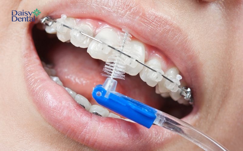 Vệ sinh răng miệng đúng cách khi chỉnh nha