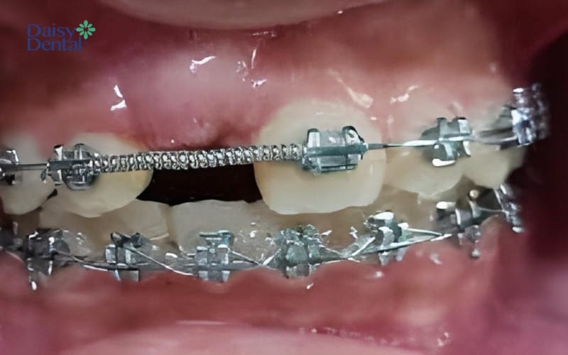 Bác sĩ sẽ kích thích răng mọc và kết hợp chỉnh nha để răng xuất hiện đúng vị trí trên cung hàm