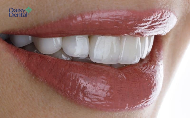 Bọc răng sứ điều trị miệng móm nhẹ