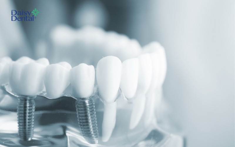 Cấy ghép răng số 7 hiện là phương pháp khôi phục răng bị mất hiện đại nhất hiện nay