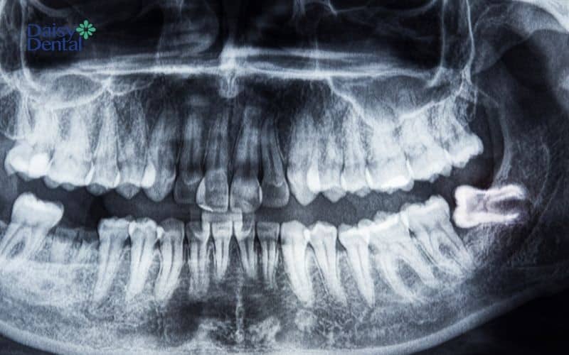 Hình ảnh răng khôn mọc lệch kẹt trong xương hàm