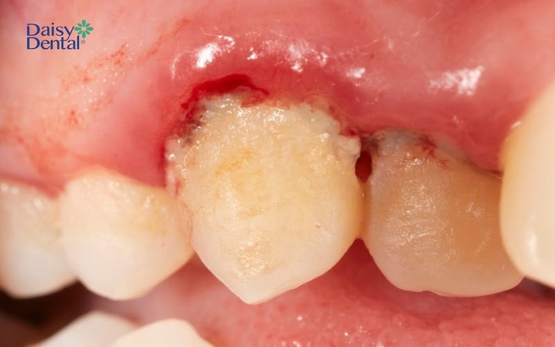 Hình ảnh viêm nướu răng khiến răng bị sưng tấy, chảy máu