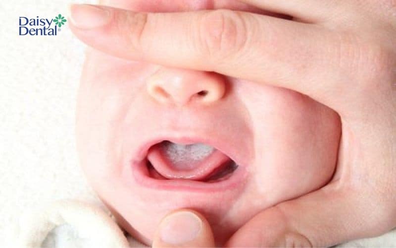 Mảng giả màu trắng, gây đau nhức và khó bong tróc trên lưỡi của bé