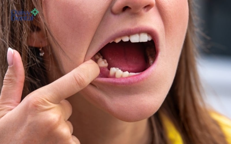 Mất răng là một trong những lý do dẫn đến thói quen nhai 1 bên