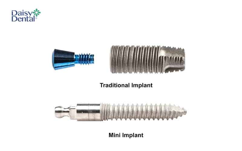 Mini Implant là phiên bản thu nhỏ của trụ Implant