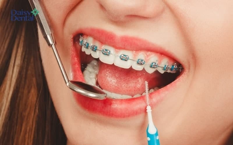 Niềng răng có thể giúp chữa mặt lệch do nhai một bên
