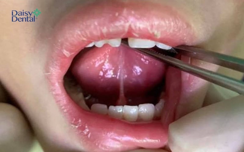 Phanh lưỡi bám thấp thường xuất hiện ở bé trai hơn ở bé gái