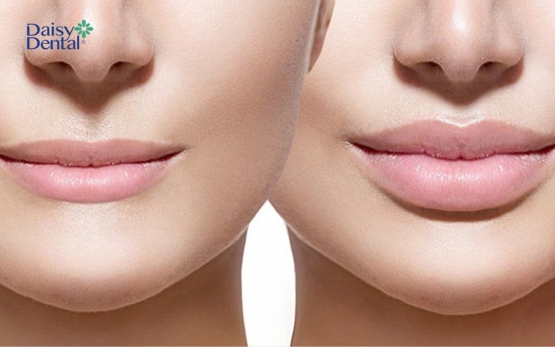 Phẫu thuật giúp bạn có đôi môi tều lâu dài