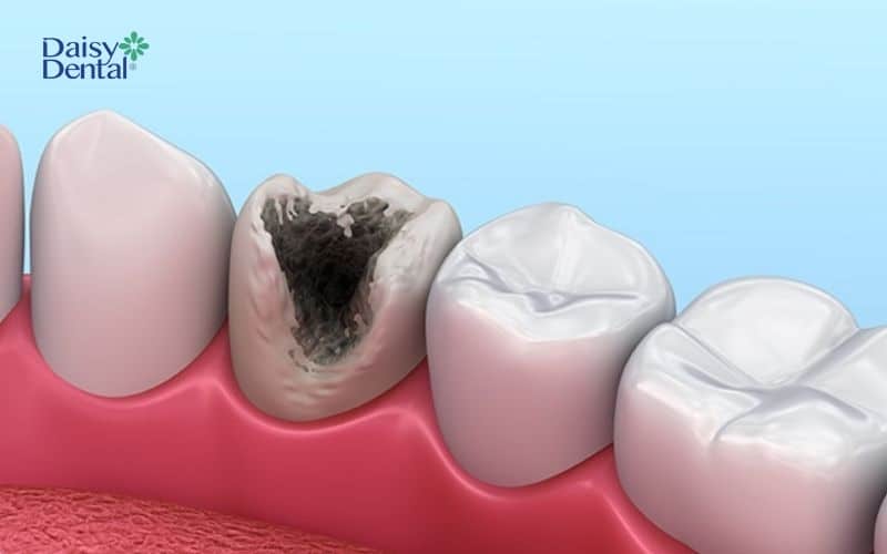Răng bị hoại tử do vi khuẩn gây sâu răng