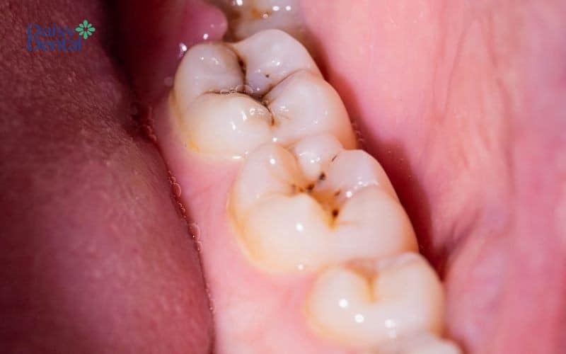Răng bị sâu nặng dẫn đến tình trạng sưng nướu