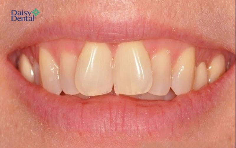 Răng cửa chữ V thường xuất hiện ở hàm trên
