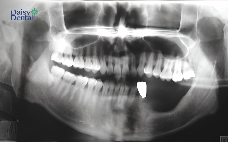 Răng số 8 mọc ngầm không được xử lý có thể hủy hoại xương hàm