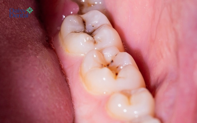 Sâu răng là một trong những nguyên nhân gây đau răng, sưng má