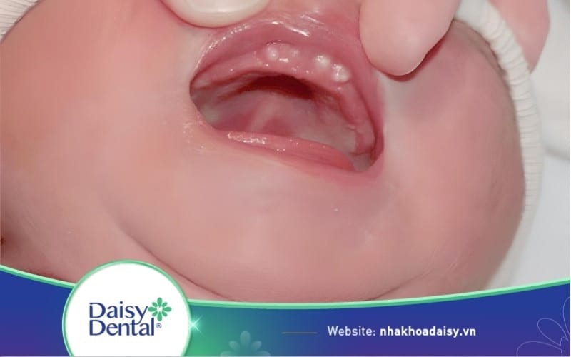 Hình ảnh bé bị nanh sữa