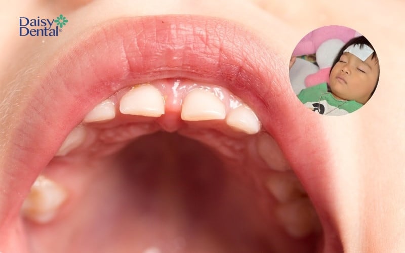 Trẻ thường bị sốt khi răng sữa bắt đầu nhú lên cung hàm