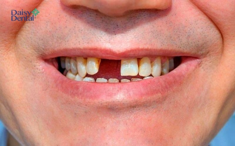 Trụ Implant MIS C1 có thể khắc phục được hầu hết các tình trạng mất răng