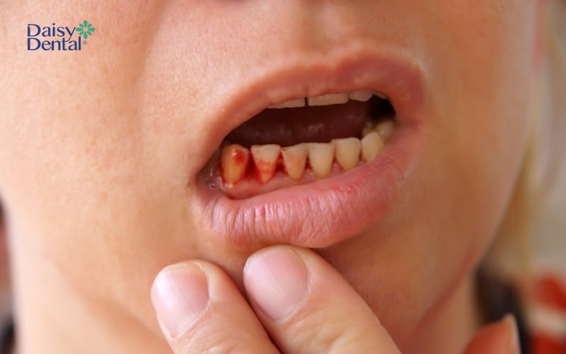 Viêm lợi gây xuất huyết chân răng kể cả khi không có tác động