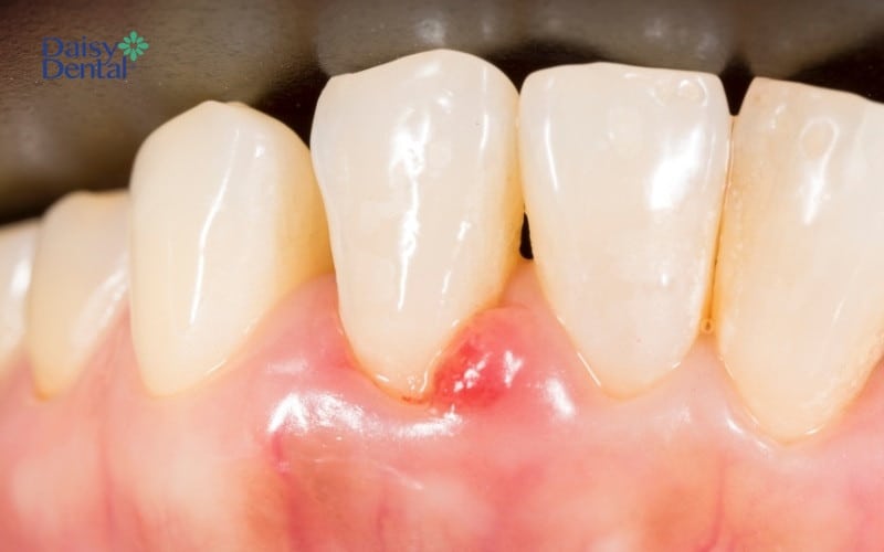 Viêm nướu răng là tình trạng mô nướu quanh chân răng bị viêm nhiễm