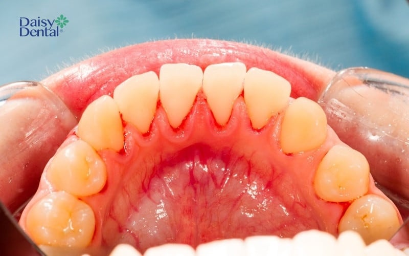 Viêm nướu răng ở mặt lợi phía trong
