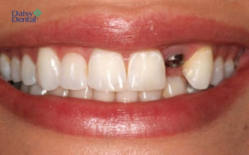 Bạn có thể cấy ghép Implant tức thì hoặc sau khi mất răng 4 - 5 tháng