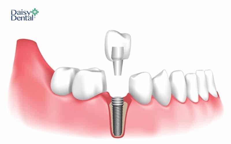 Cấy ghép Implant là quá trình đặt trụ Implant vào trong xương hàm thay thế cho răng đã mất