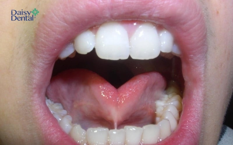 Dính thắng lưỡi ảnh hưởng đến việc phát âm của các em