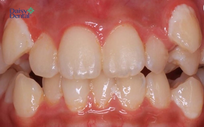 Hình ảnh răng mọc trên lợi phổ biến