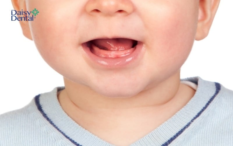 Lợi sưng đỏ là dấu hiệu cho thấy trẻ sắp mọc răng