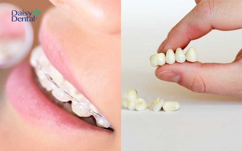Nên bọc sứ hay niềng răng sẽ phụ thuộc vào tình trạng răng miệng
