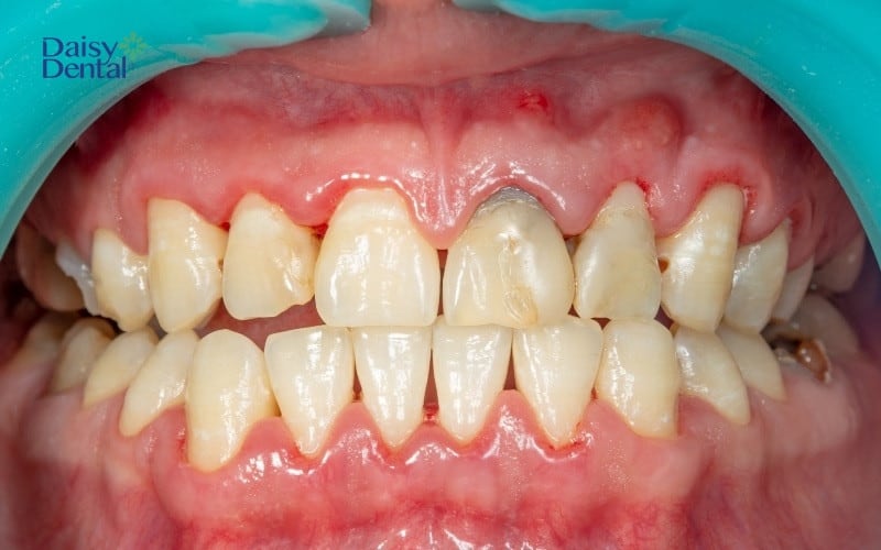 Nướu tách khỏi thân răng có thể do yếu tố di truyền, bẩm sinh