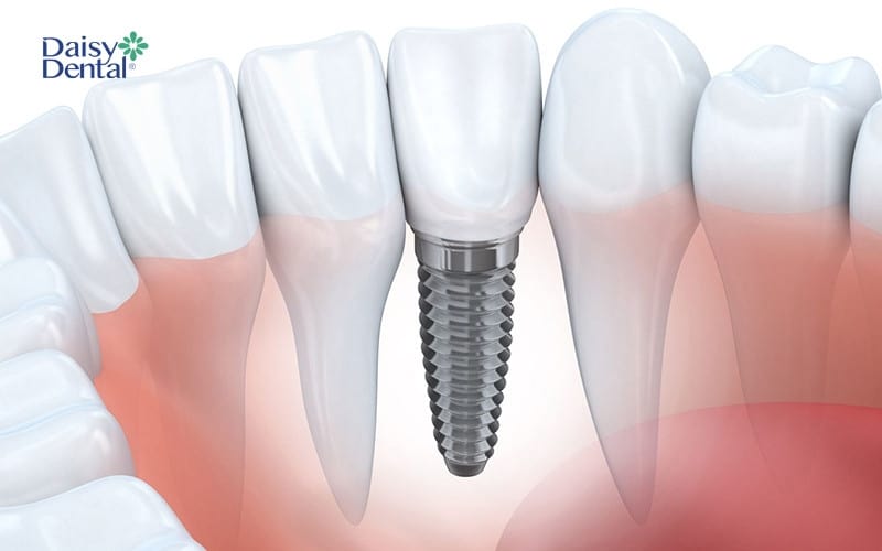 Phương pháp trồng răng Implant cực kỳ an toàn